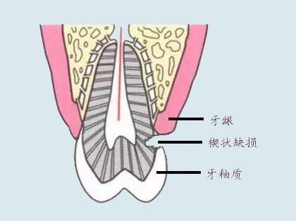 <b>什么是楔状缺损</b>