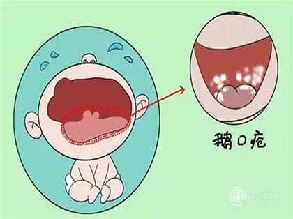 <b>口腔念珠菌病的症状</b>