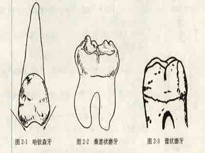 <b>什么是先天性梅毒牙</b>