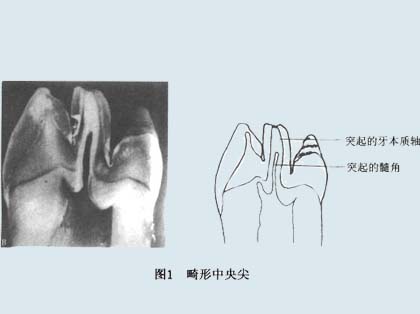 畸形中央尖是怎么引起的