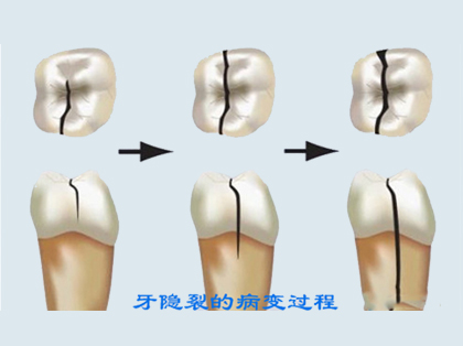 <b>什么是牙隐裂</b>