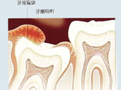 <b>一般什么时候会长智齿</b>
