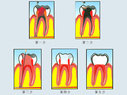 <b>什么是根尖诱导成形术</b>