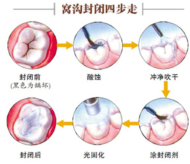 小孩防龋是否要做窝沟封闭？